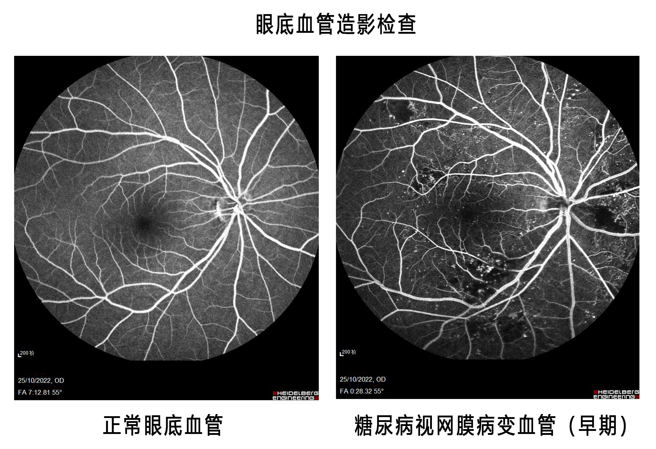 视网膜血管性疾病——1、视网膜静脉阻塞 - 知乎