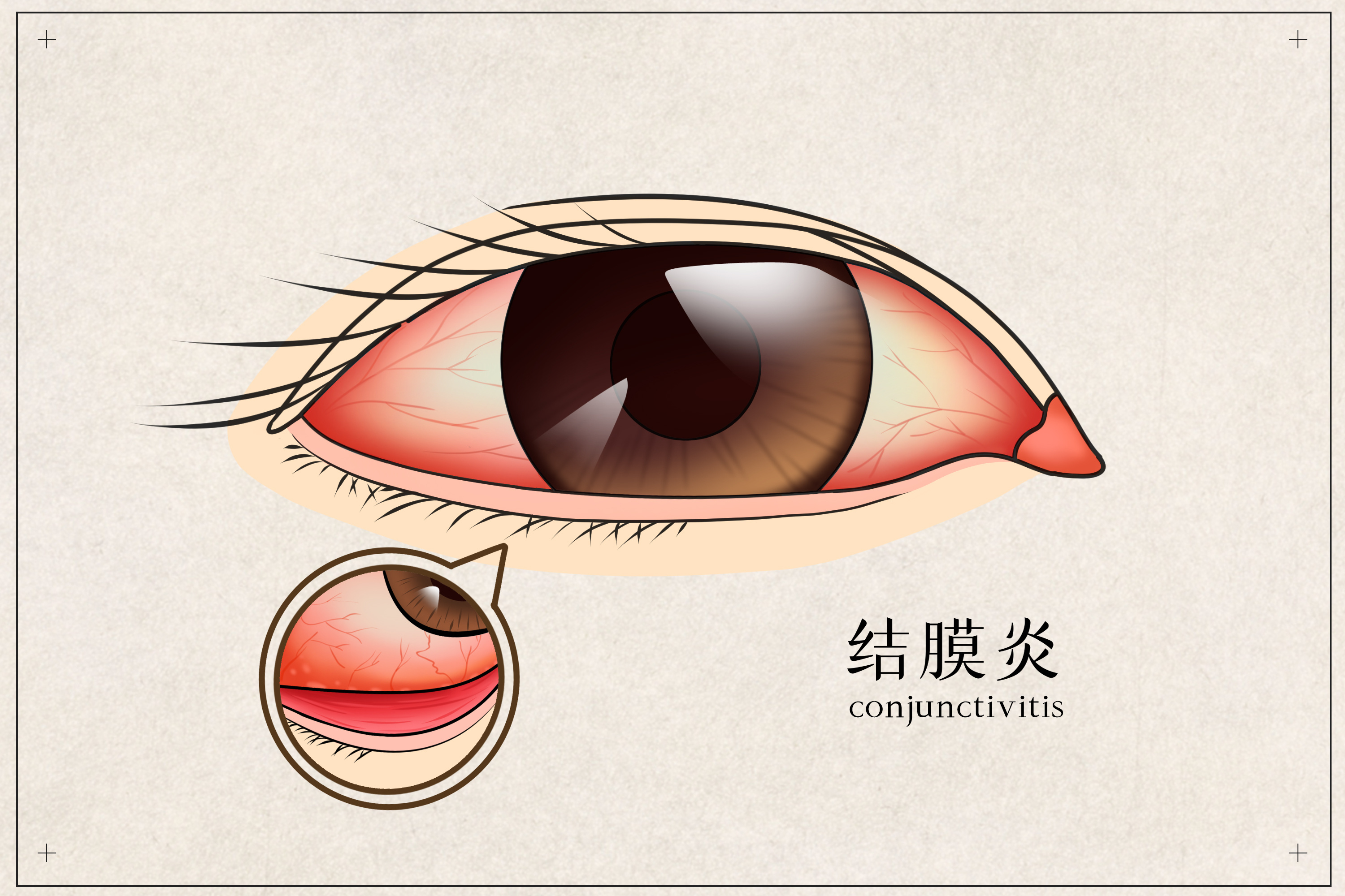 右眼眼角长了个白疙瘩，是在眼睛里面，这是个什么东西，不痛不痒，需要去医院看吗_百度知道